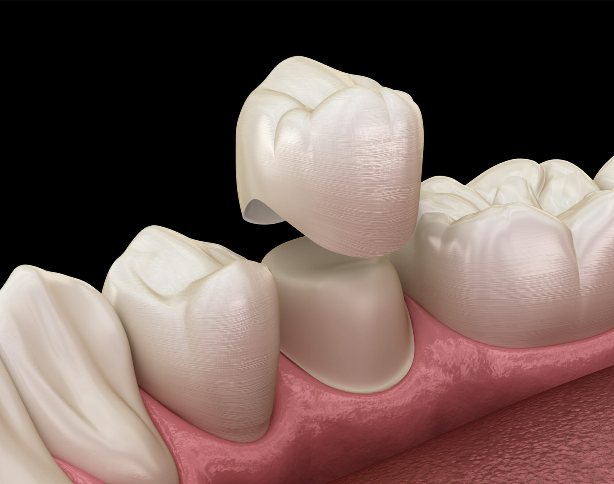 dental crowns