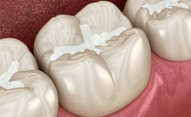 tooth colored dental fillings